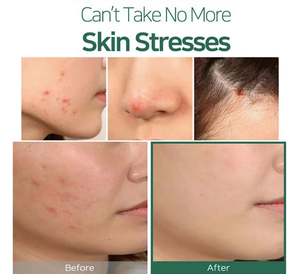 ket-qua-tinh-dau-tram-tra-some-by-mi-30-days-miracle-tea-tree-clear-spot-oil-10ml