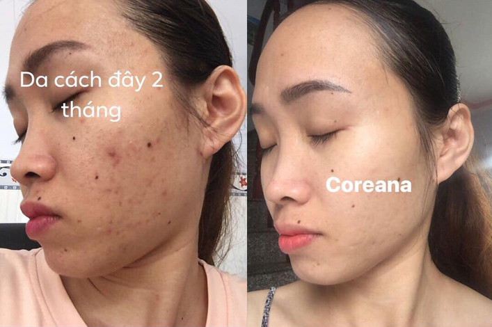 review-kem-tri-nam-nacos-han-quoc-3