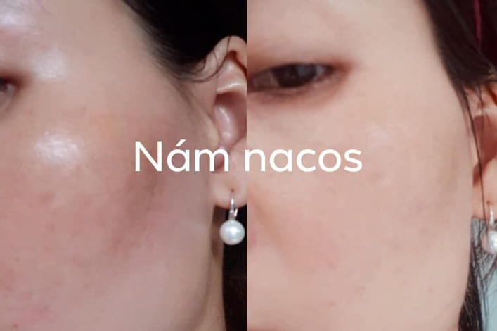 review-kem-tri-nam-nacos-han-quoc-4