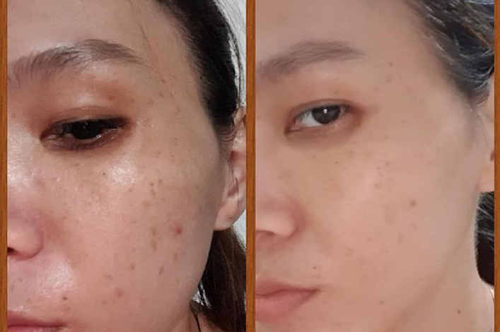 review-kem-tri-nam-nacos-han-quoc-5